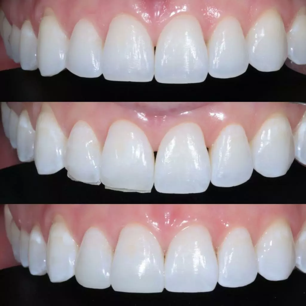 facetas-e-resinas-01