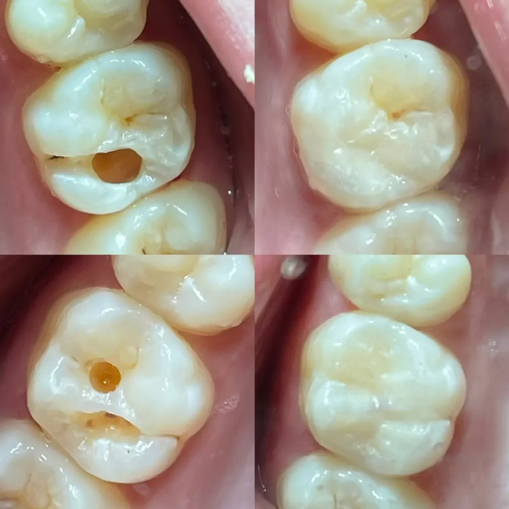 facetas-e-resinas-02