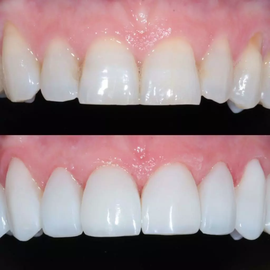 facetas-e-resinas-03