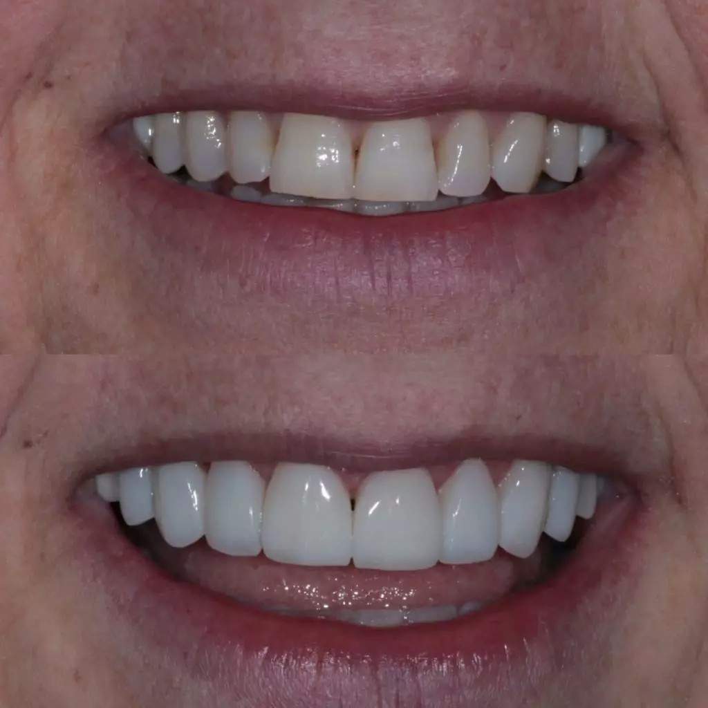 facetas-e-resinas-04
