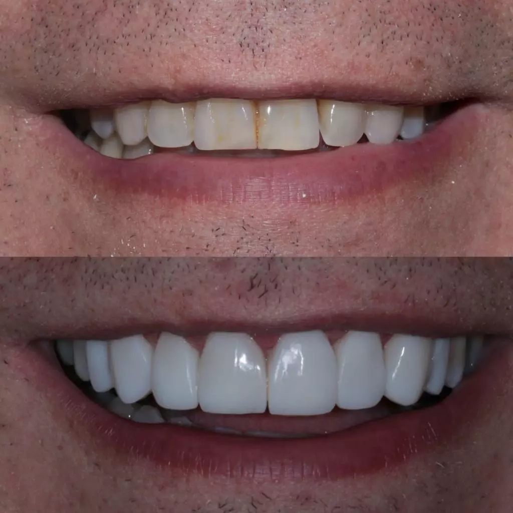 facetas-e-resinas-05