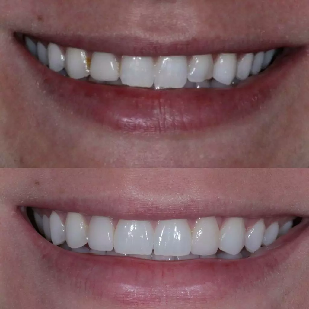facetas-e-resinas-07