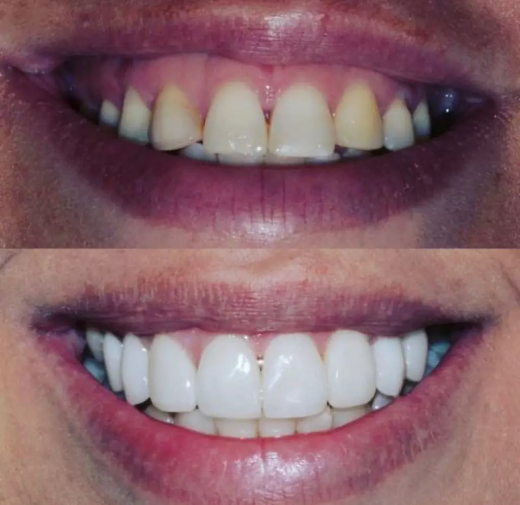 facetas-e-resinas-08