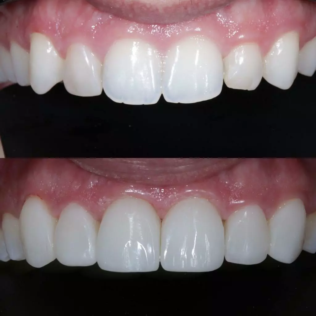 facetas-e-resinas-09
