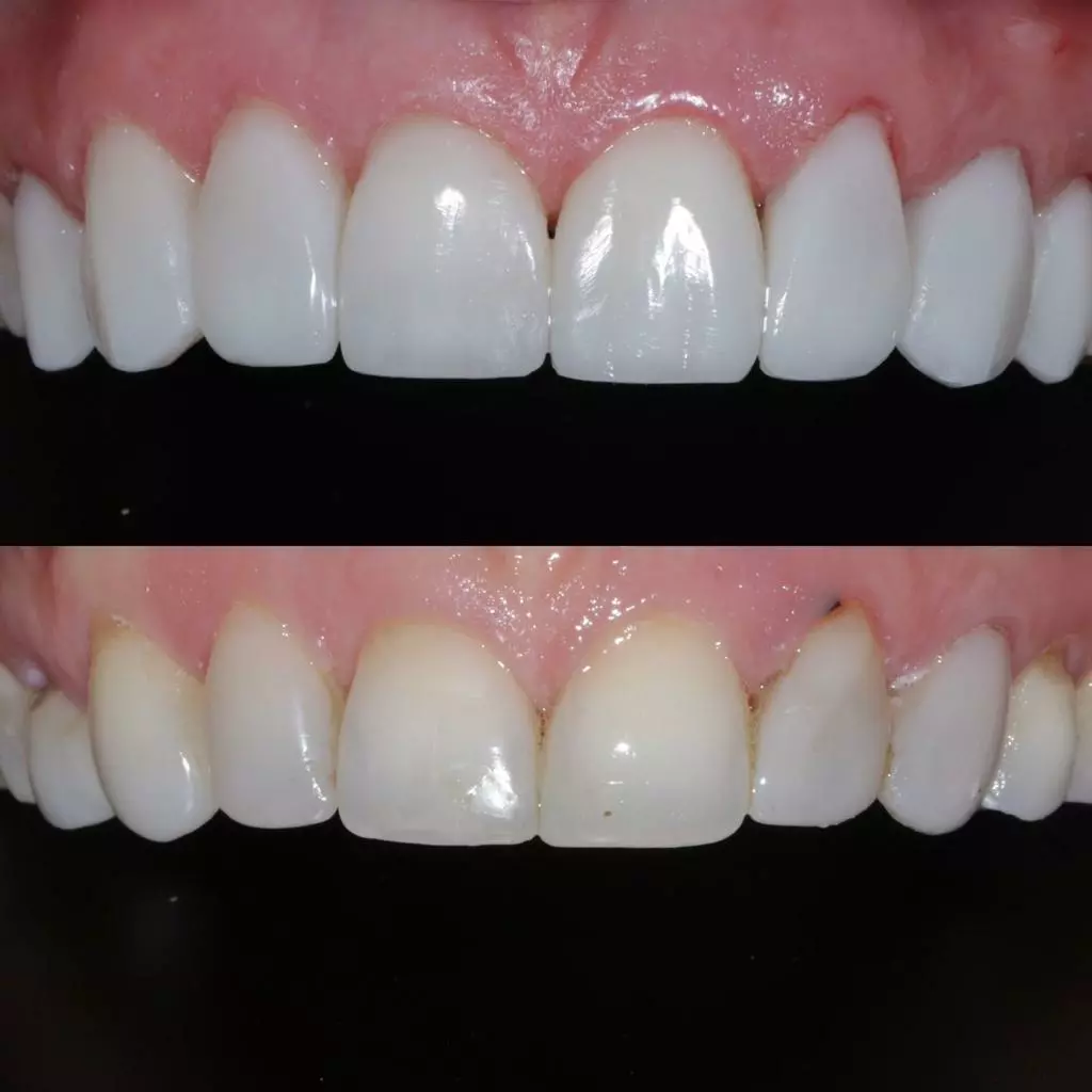 facetas-e-resinas-10