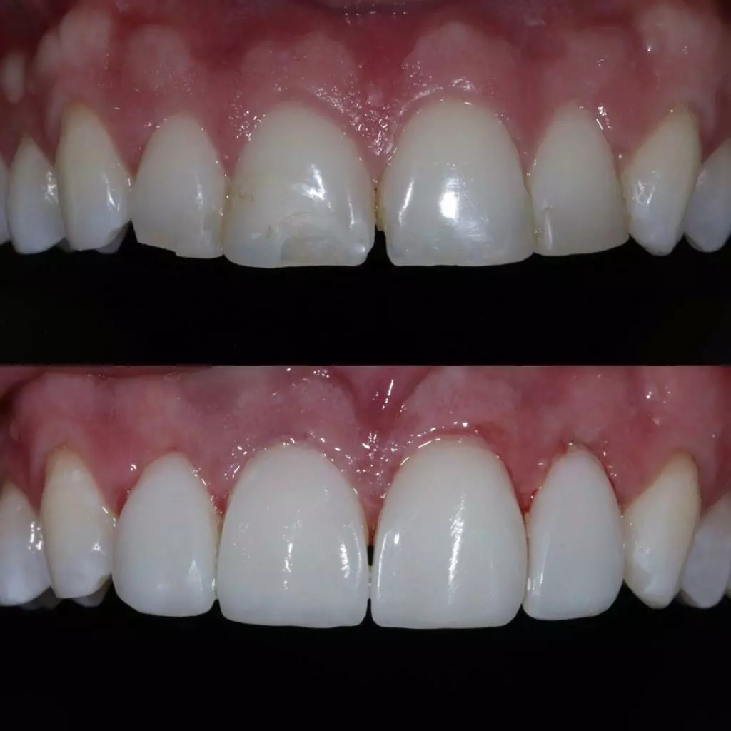 facetas-e-resinas-11