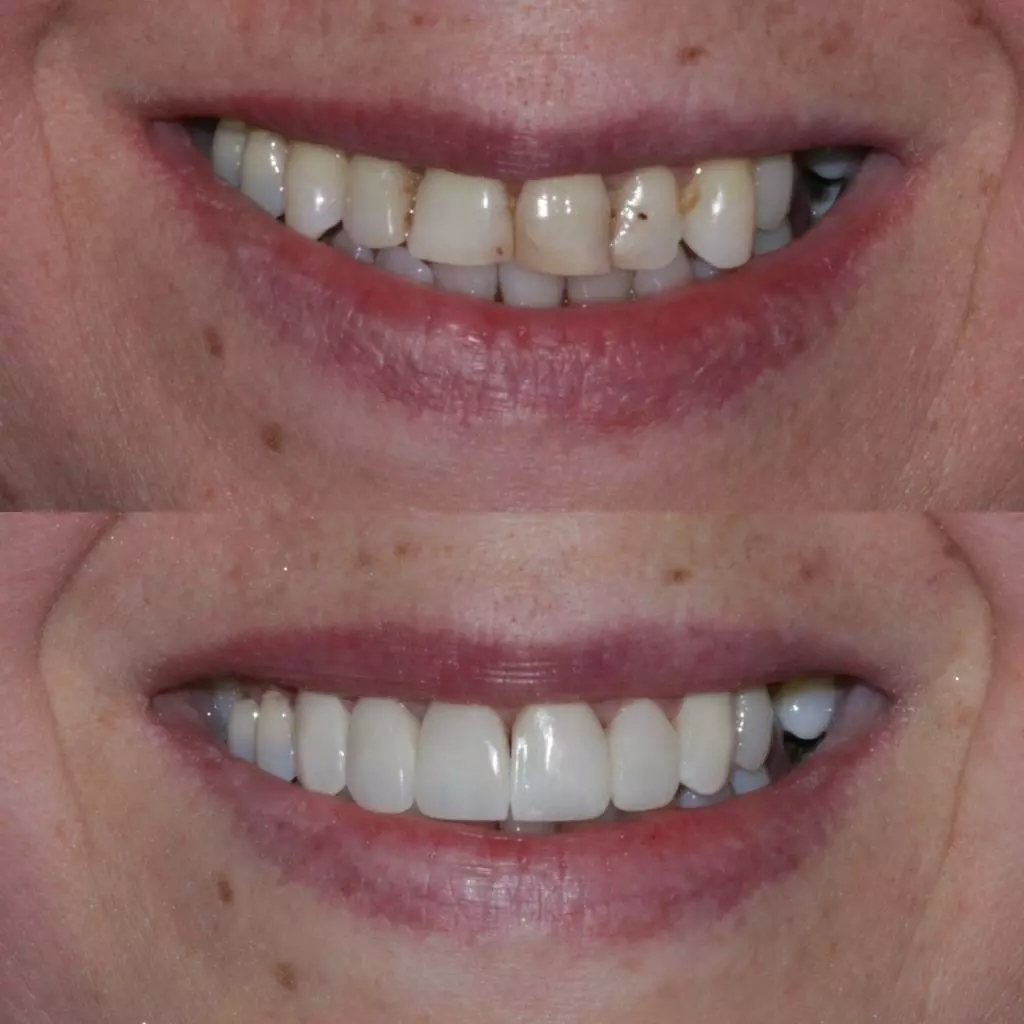 facetas-e-resinas-12