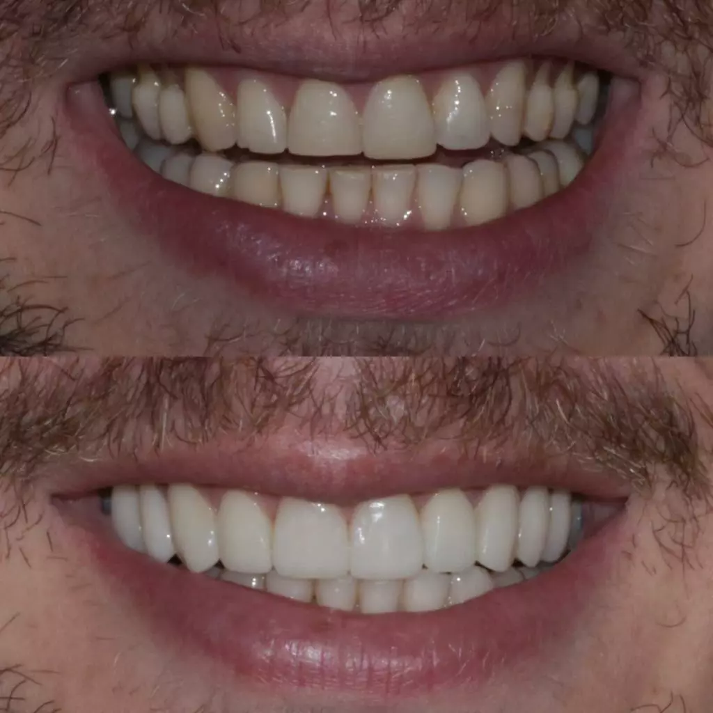 facetas-e-resinas-13