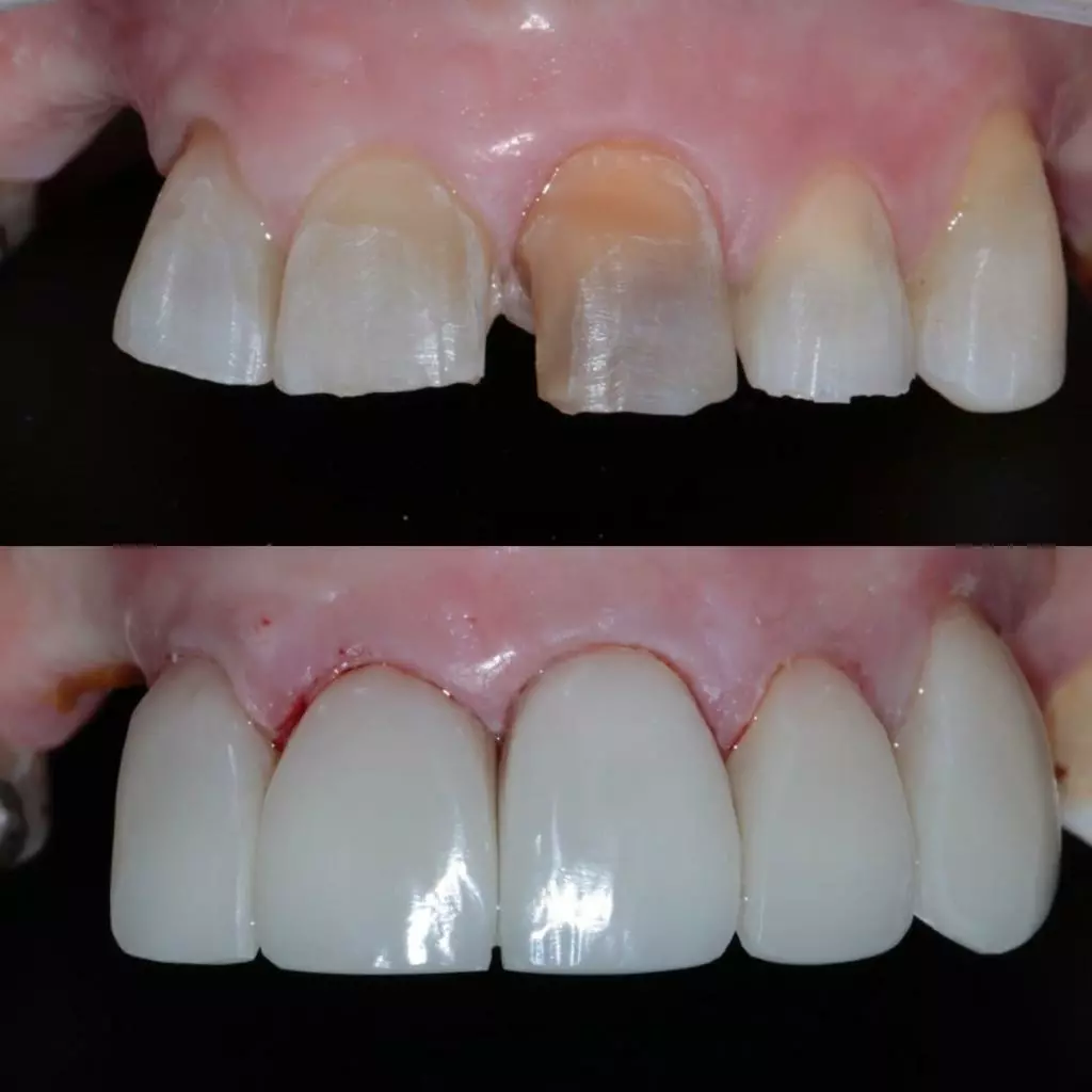 facetas-e-resinas-14